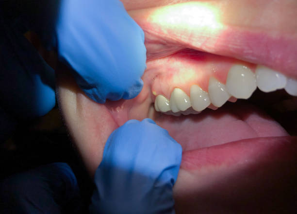 Best Emergency Broken Tooth Repair in St Anne, IL